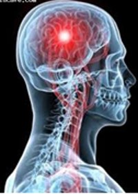 aneurizma neurohirurgija